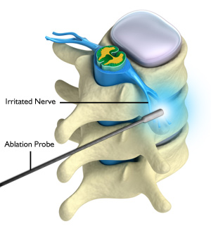 Epidural