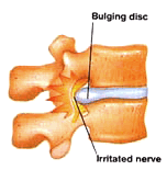 Epidural